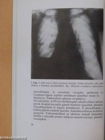 A tuberculosis ma