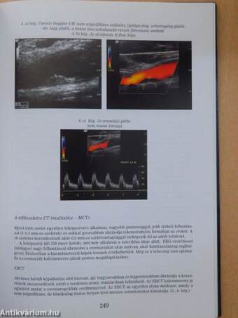 Atherosclerosis