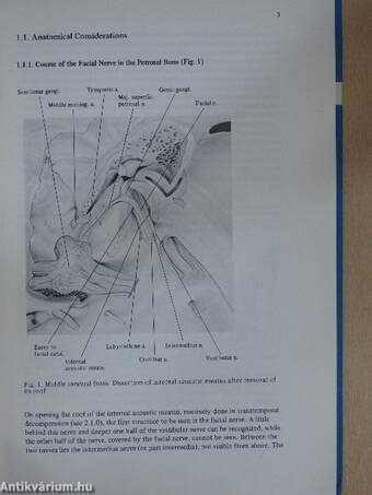 The Acute Facial Palsies 