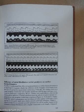 Atrial Fibrillation