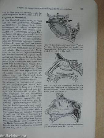 Operative Eingriffe an Nase, Nasen- und Mundrachen, Hypopharynx, Kelkopf und äußerem Hals