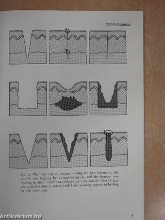 Sutures and Techniques for Wound Closure