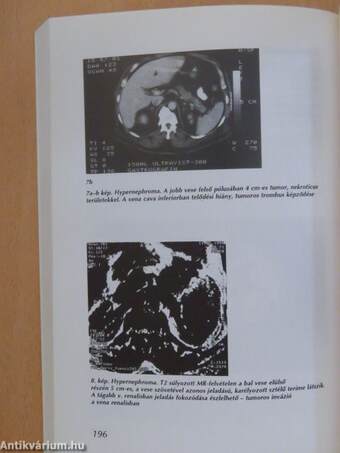 A here és vesedaganatok diagnosztikája és terápiája 