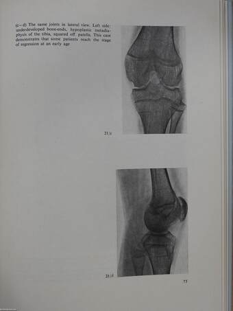 Radiology of Haemophilic Arthropathies (dedikált példány)