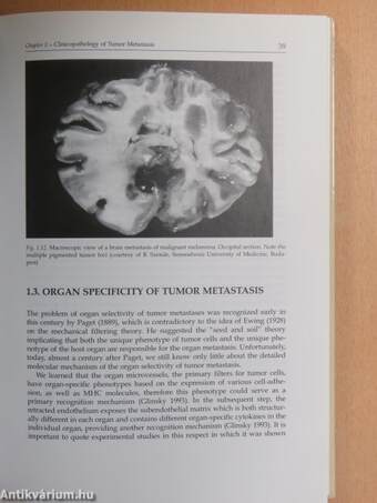 Diagnosis and Surgery of Organ Metastases