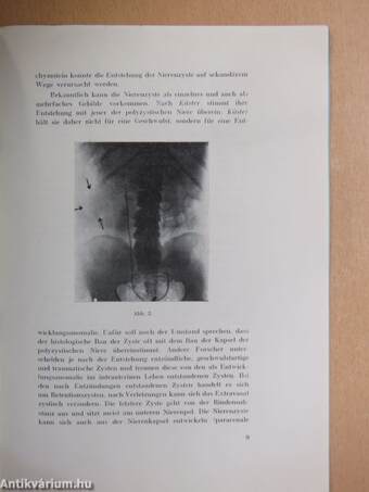 Recklinghausensche Krankheit und Nierenzyste