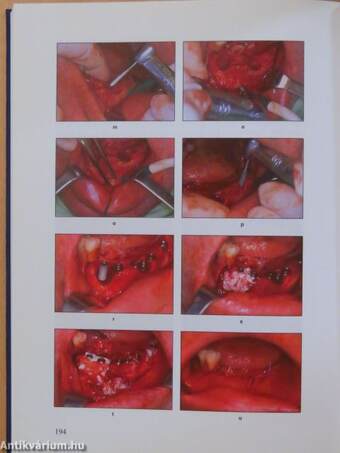 A gyakorló fogorvos implantológiája