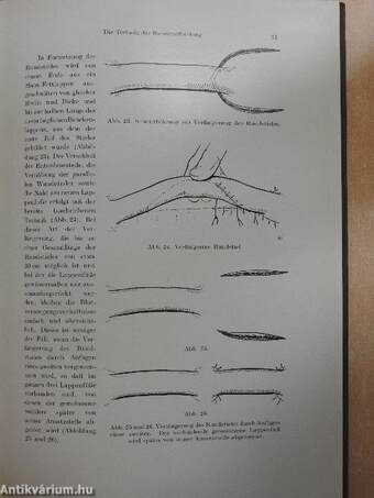 Der Rundstiellappen in der Wiederherstellungschirurgie des Gesichts-Kieferbereiches