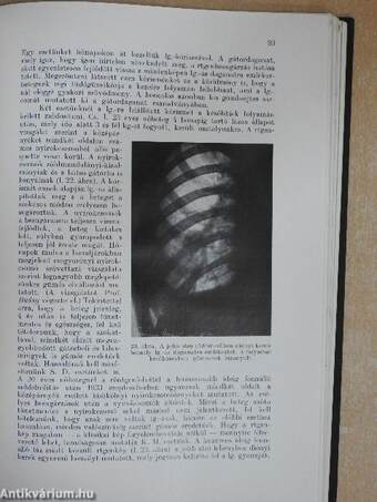 A lymphogranulomatosis kór- és gyógytana