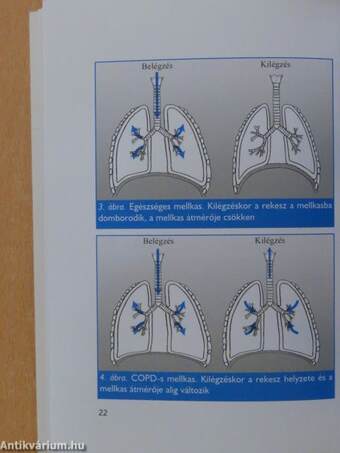 Fulladok, köhögök - COPD-s vagyok?