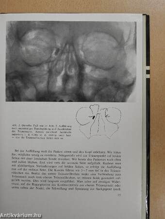 Die röntgendiagnostik der tränenableitenden wege