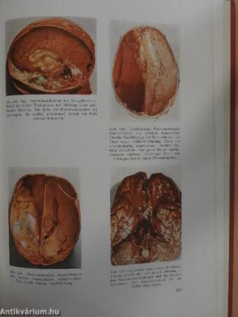 Atlas Der Pathologischen Anatomie