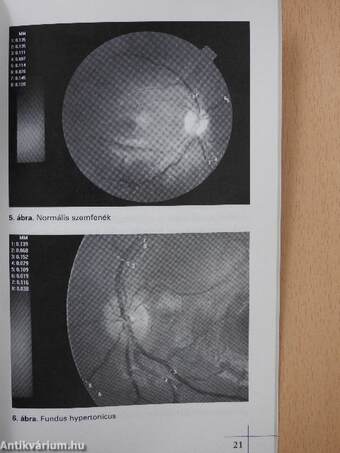 Az érelmeszesedést elősegítő rizikófaktorok csökkentésének lehetőségei a gyermekgyógyászatban