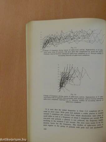 Epilepsy and 3 per second spike and wave rhythms