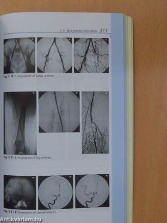 Glaucoma