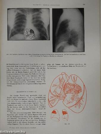 Röntgenanatomische Grundlagen Der Lungenuntersuchung