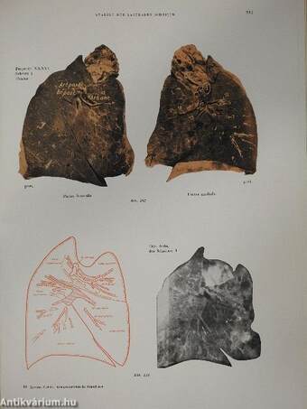 Röntgenanatomische Grundlagen Der Lungenuntersuchung