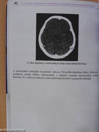 Stroke-prevenció