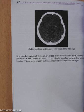 Stroke-prevenció