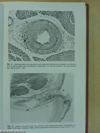 Nonatherosclerotic Ischemic Heart Disease