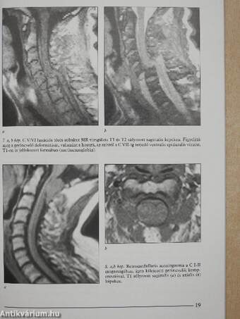 A nyaki gerinc képalkotó diagnosztikája