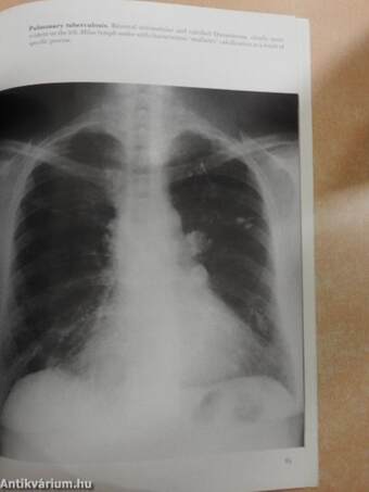 Thoracic Pathology Illustrated