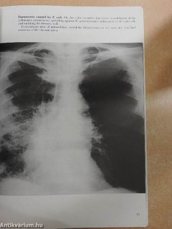 Thoracic Pathology Illustrated