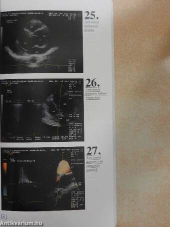 A színkódolt doppler echocardiographia atlasza