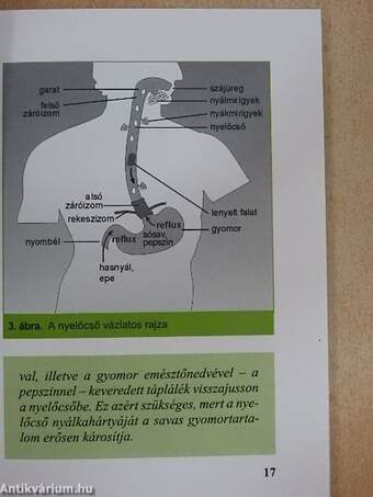 Refluxbetegség - gyomorsav okozta bántalmak