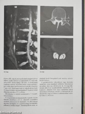 Lumbalis spinalis stenosis