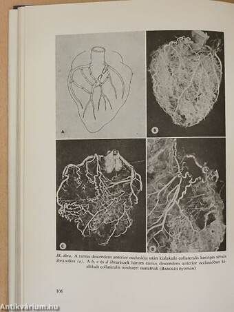 Myocardialis infarctus