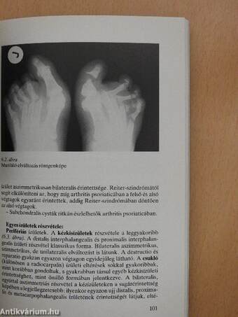 Arthritis psoriatica