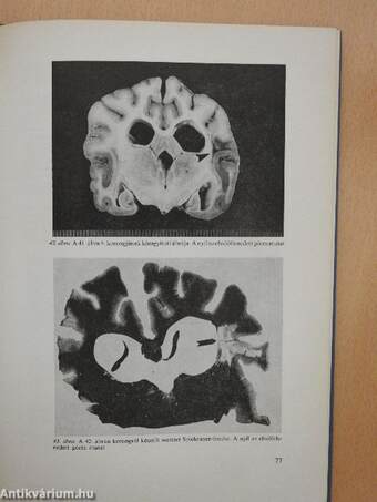 Sclerosis multiplex