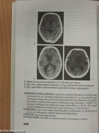 Az Alzheimer-kóros betegek gondozása