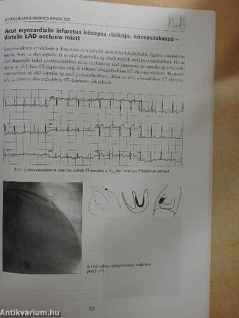 Acut myocardialis infarctus és instabil angina az EKG tükrében