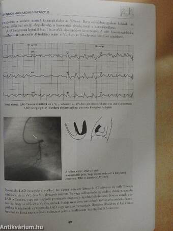 Acut myocardialis infarctus és instabil angina az EKG tükrében