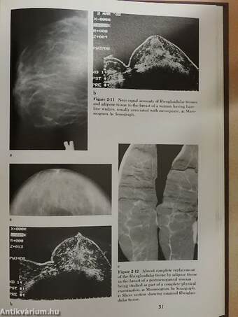 Ultrasound Mammography