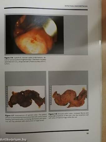 An Atlas of Endometriosis