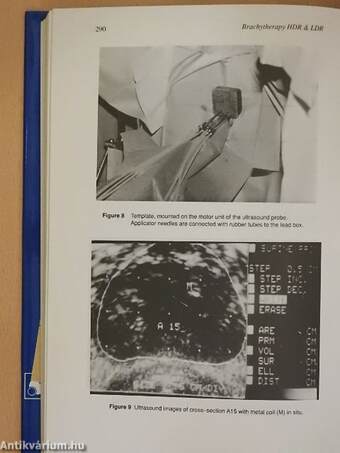 Brachytherapy HDR and LDR