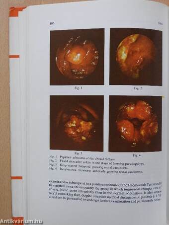 Early Detection of Colorectal Cancer