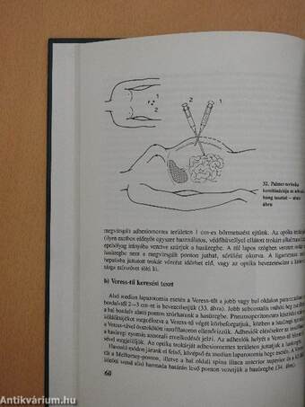 Laparoscopos Cholecystectomia