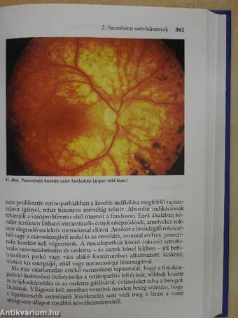 Diabetes mellitus