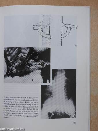 A renovascularis hypertonia sebészete