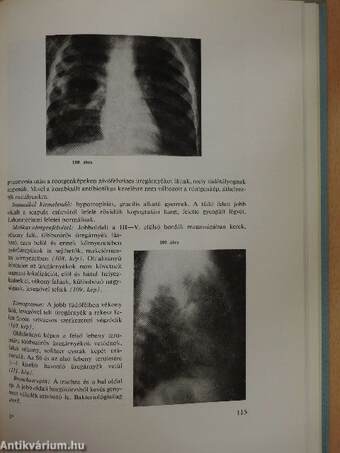 Csecsemő- és kisdedkori ismétlődő pneumoniák diagnosztikája és therapiája