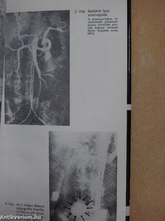 A felnőttkori spontán hypoglykaemiás tünetegyüttes