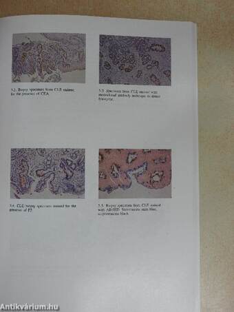 Columnar-Lined (Barrett's) Esophagus