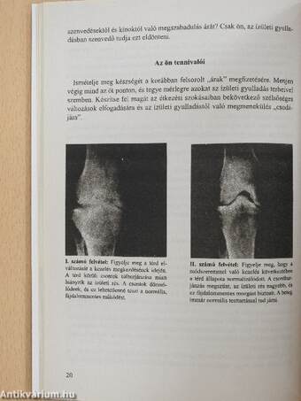 Házi gyógymódok az ízületi gyulladásra