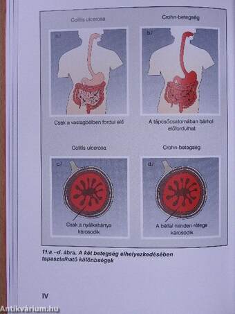 Gyulladásos bélbetegségek