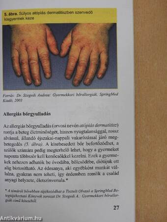 Allergia - öröklődés - megelőzés