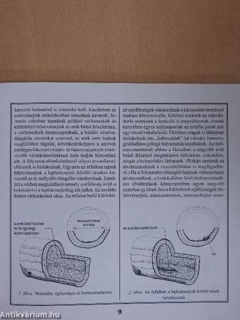 A szívinfarktus és étrendi kezelése